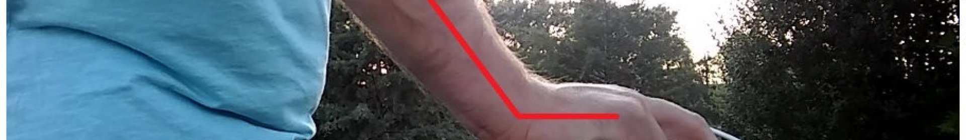 Carpal Tunnel Syndrome