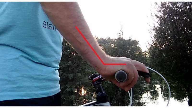 Carpal Tunnel Syndrome